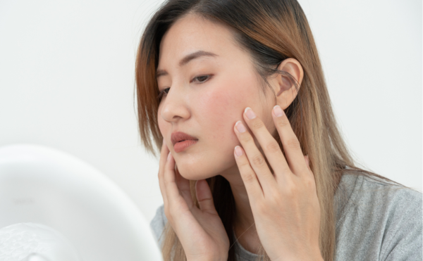 Acne Teleconsult