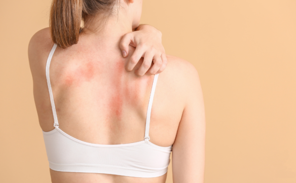 Skin Conditions Teleconsult