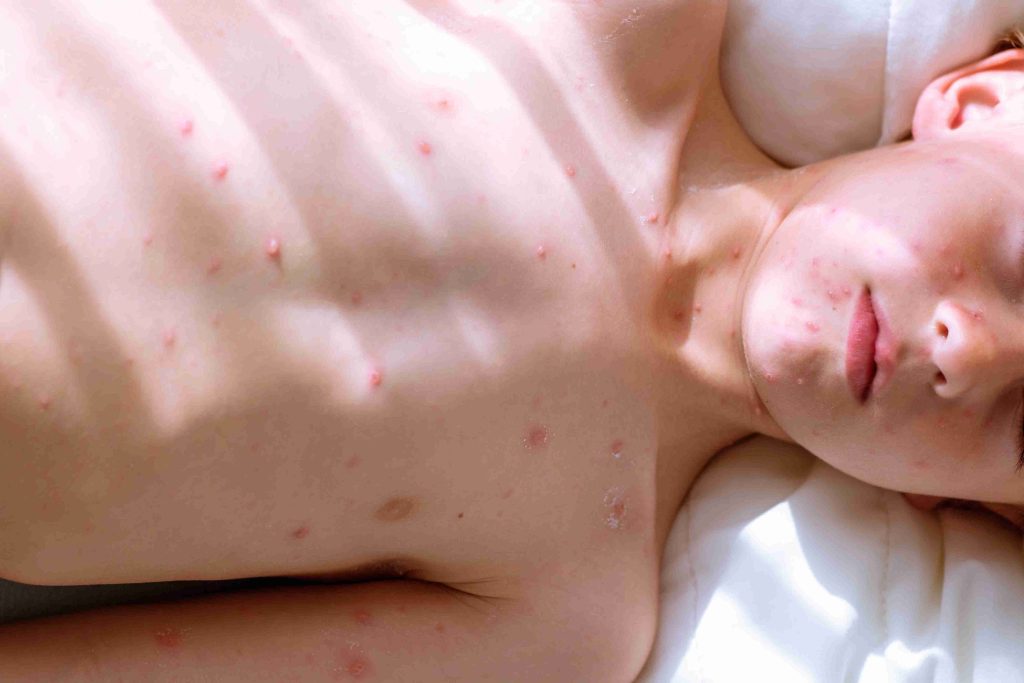 Child with chickenpox lying down in bed.