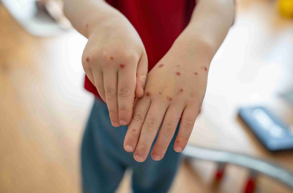Image of a child's hands with red spots.